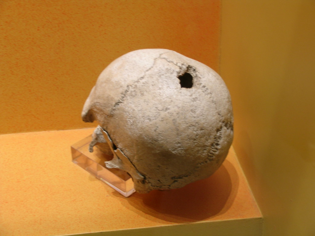 trepanning