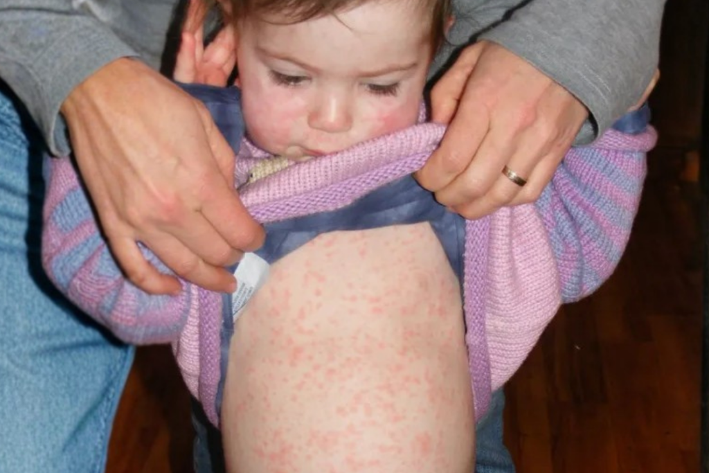 Child skin rashes measles